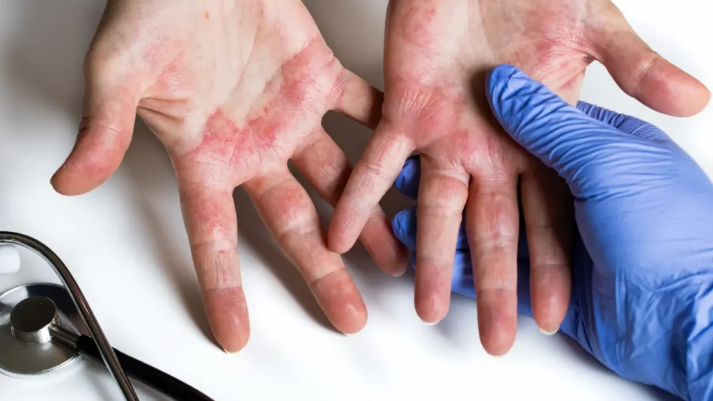 Tipos de alergia nas mãos