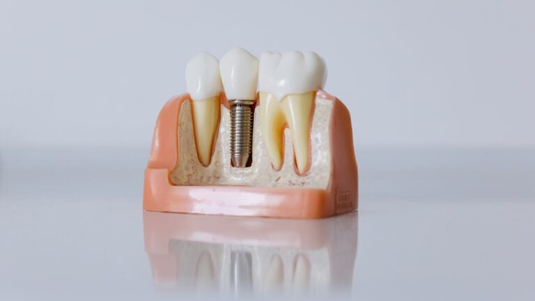 Quanto custa uma prótese protocolo sobre implante?