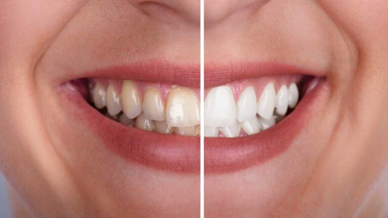 Clareador dental dói a genviva? Entenda tudo