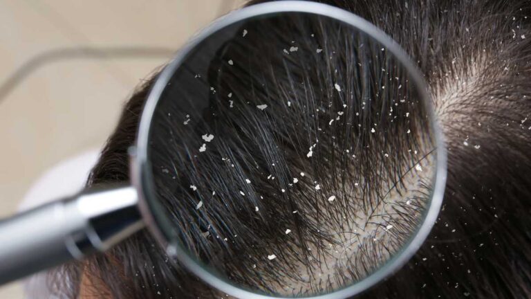Minoxidil gera caspa?